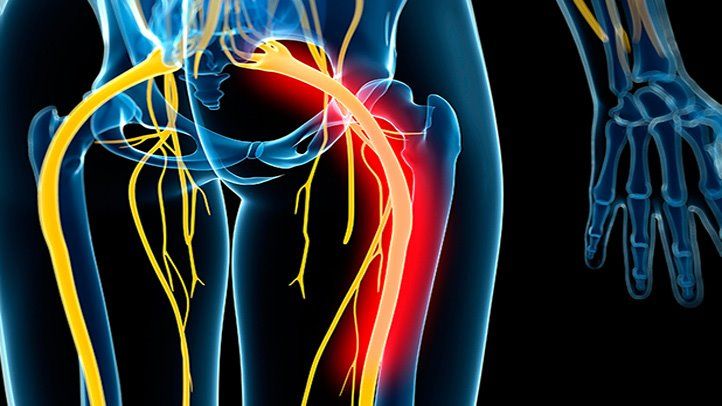 Understanding the Causes of Sciatica Pain