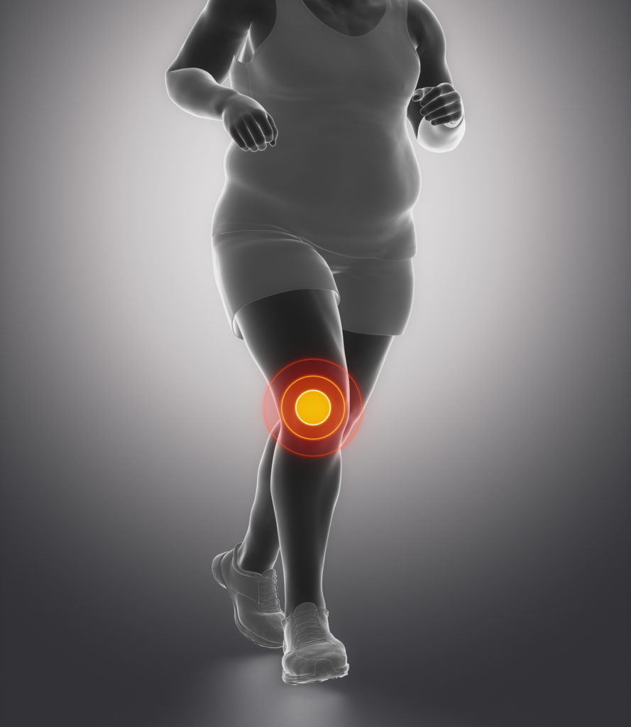 The Link Between Obesity and Knee Pain
